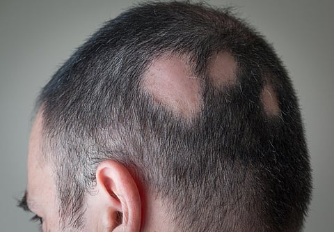 alopecia