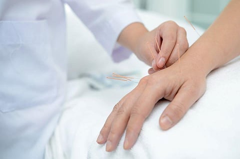 acupuncture