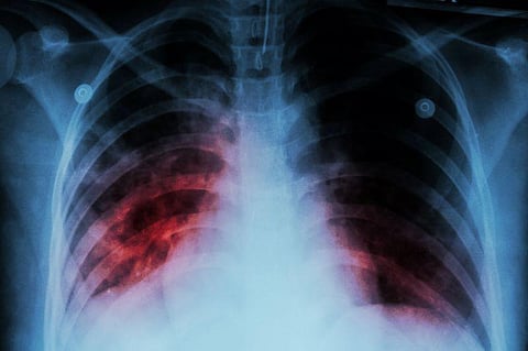 tuberculosis
