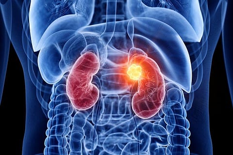 kidney cancer
