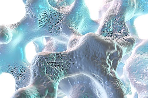osteoporosis