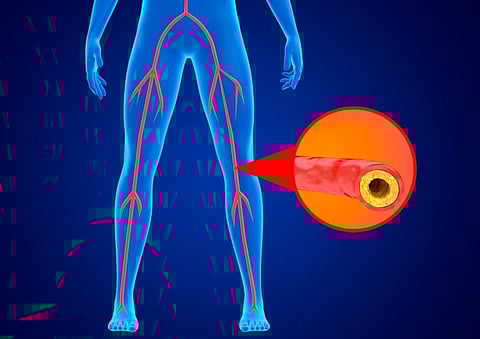leg ischemia