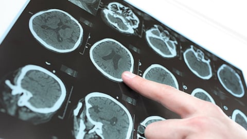 Gene Mutation Protects Against Parkinson's Disease