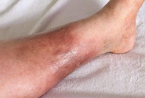 cellulitis