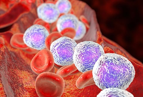 acute lymphoblastic leukemia