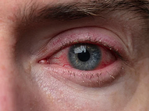 bloodshot