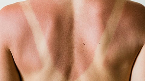 Según un estudio, las vacaciones en las que buscas exponerte al sol podrían alterar el microbioma de tu piel de forma poco saludable