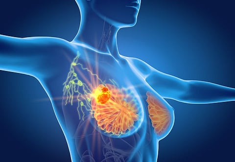 Prediction Model for Invasive Breast Cancer Improved With Additional Risk Factors
