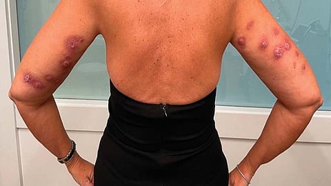 Multiple infected knots at injection sites from a woman who received injections with Lipodissolve