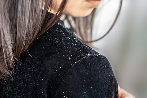 What Is Dandruff & How Is It Treated?