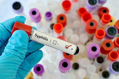 U.S. Syphilis Cases Continue to Climb
