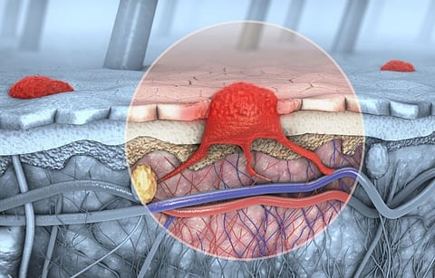 Early FDG PET/CT Can ID Metabolic Changes in Advanced Melanoma