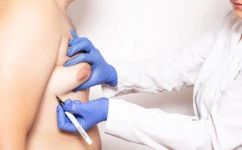 Gynecomastia Linked to Increased Risk for Death