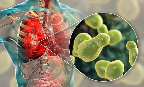 Guidelines Developed for Diagnosis, Management of Cryptococcosis