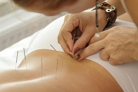 Acupuncture May Lower Stroke Risk in Rheumatoid Arthritis Patients