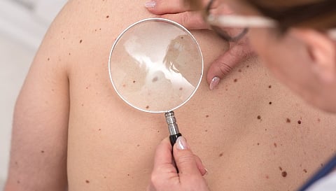 Delayed Melanoma Care During Pandemic Proved Costly