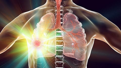 Tislelizumab Plus Chemotherapy Beneficial for Resectable NSCLC