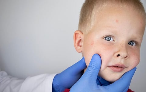 Florida Surgeon General Defies CDC Guidance Amid School Measles Outbreak