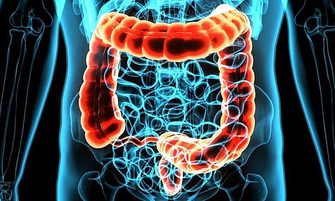Multitarget Stool DNA Test Has Higher Sensitivity for CRC Than FIT