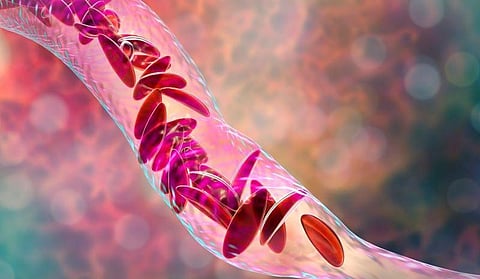 Crude Sickle Cell Birth Prevalence 28.54 per 10,000 in Non-Hispanic Blacks