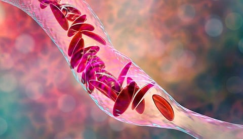 Exa-Cel Eliminates Vaso-Occlusive Crises in Most Sickle Cell Patients