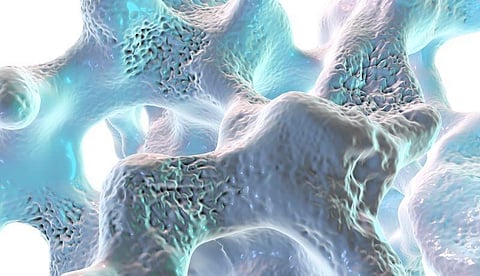 Osteoporosis Screening Rates Low for Asian American Medicare Beneficiaries