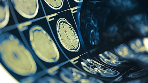 Surgical Removal Beneficial for Acute Intracerebral Hemorrhage