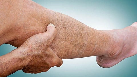 Updated Guidance Issued for Managing Lower-Extremity Peripheral Artery Disease