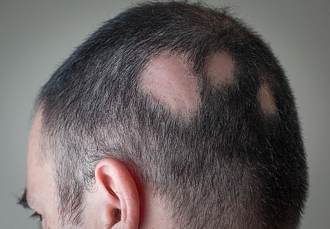 alopecia