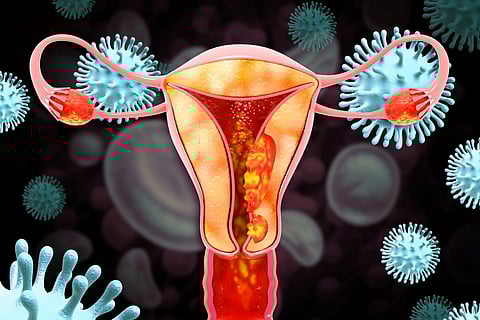 endometrial uterine cancer