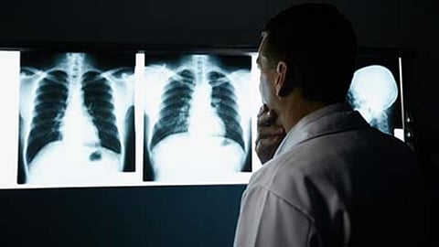 lung cancer x-rays