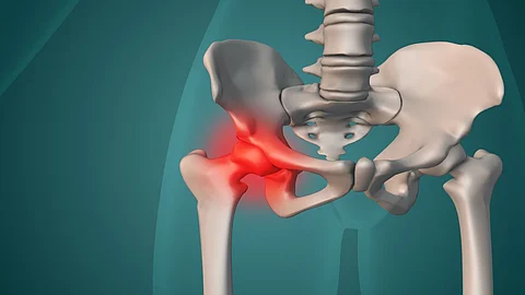 hip fracture