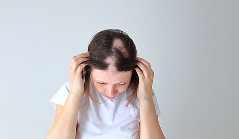 alopecia