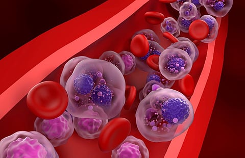 multiple myeloma