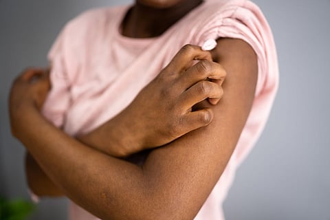 black skin itch psoriasis eczema