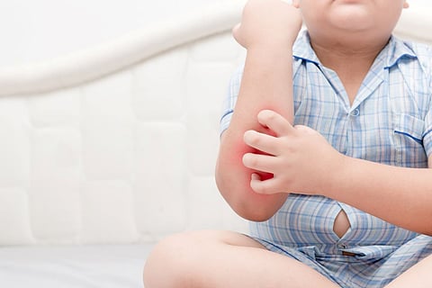 obesidad infantil dermatitis cutánea picazón