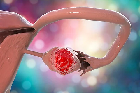 ovarian cancer
