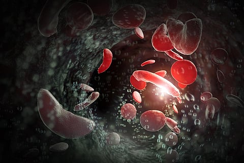 sickle cell