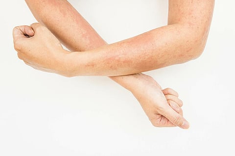 rash infection fungus