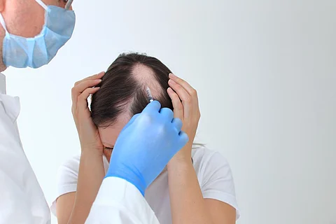 alopecia areata