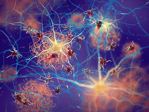 Placas amiloides que se forman entre las neuronas. Proteína beta-amiloide que altera la función de las células nerviosas en un cerebro con enfermedad de Alzheimer