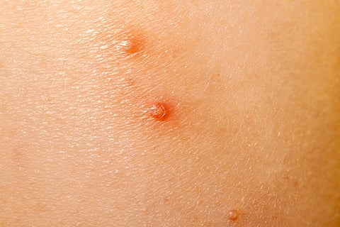 molluscum contagiosum