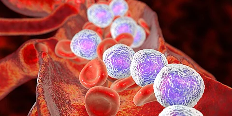 Leucemia linfoblástica aguda, ilustración 3D que muestra abundantes linfoblastos en sangre