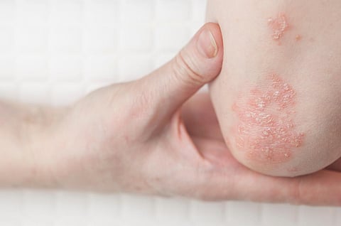 psoriasis