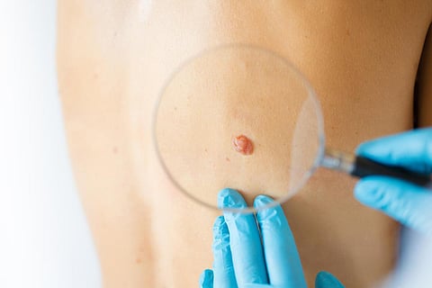 skin lesion mole cancer