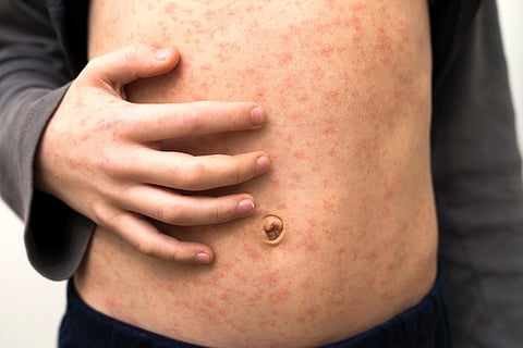 measles rash child