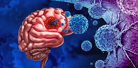 glioma cancer brain tumor