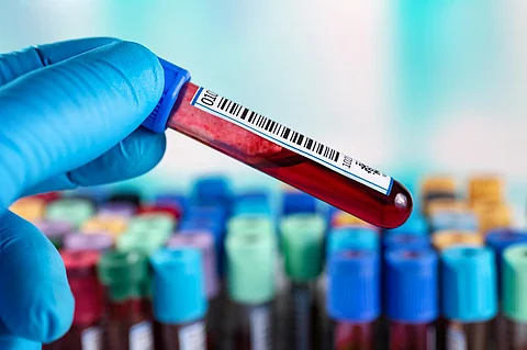 hand holding tube in hemolyzed blood sample in coagulation. Blood sample for coagulation test in the laboratory