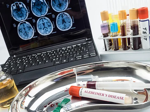 Muestra de sangre para investigar el remedio contra la enfermedad de Alzheimer, imagen conceptual