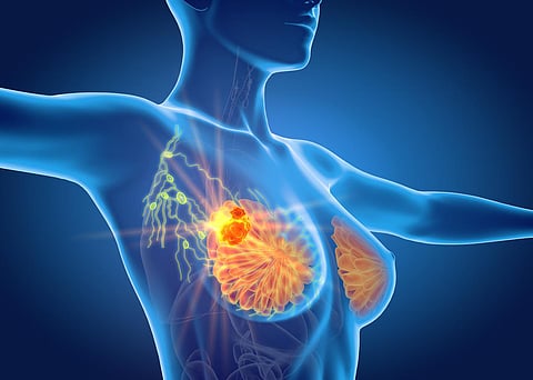 breast cancer lymph nodes